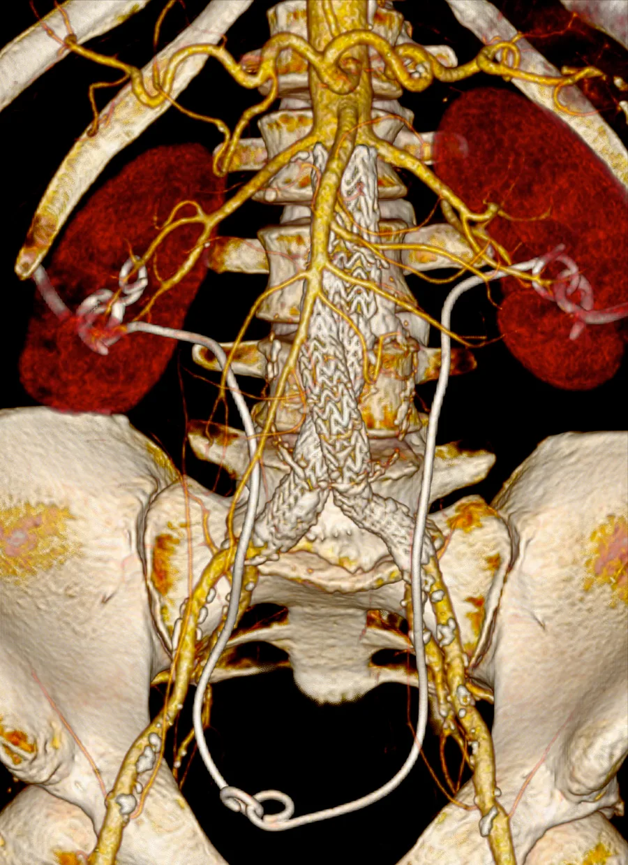 Aneurismas de aorta — Reparación Endovascular (EVAR/TEVAR)