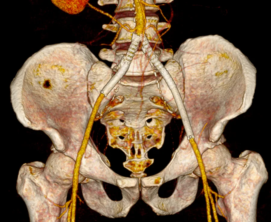 Enfermedad arterial periférica — Revascularización Endovascular